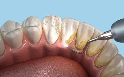 Teeth Cleaning & Scaling