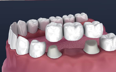 Dental Crowns & Bridges