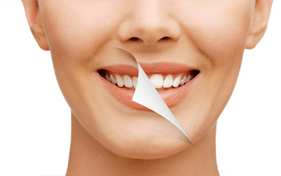 Smile Designing