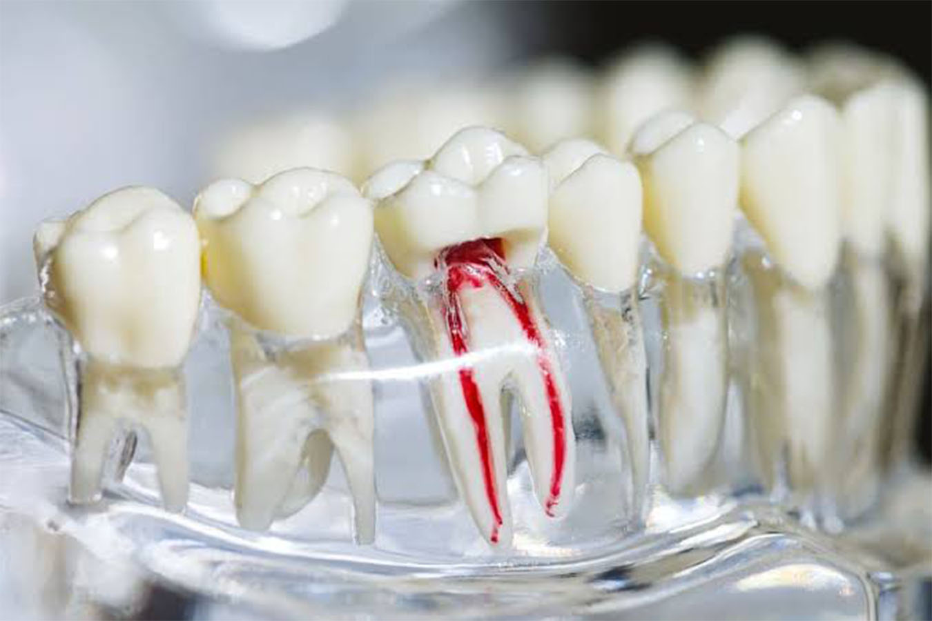 Root Canal Treatment In Ulwe