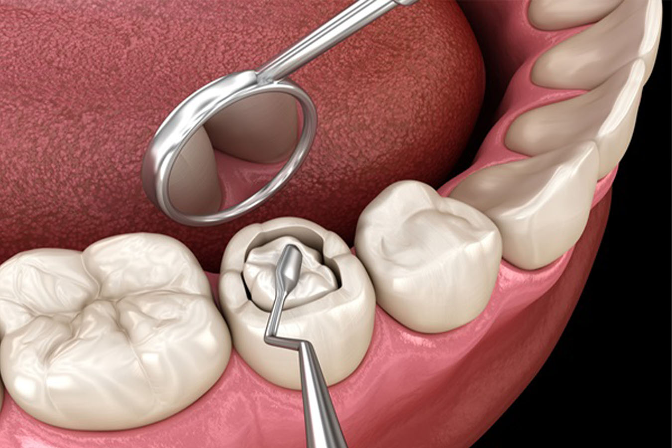 Tooth Filling in Ulwe