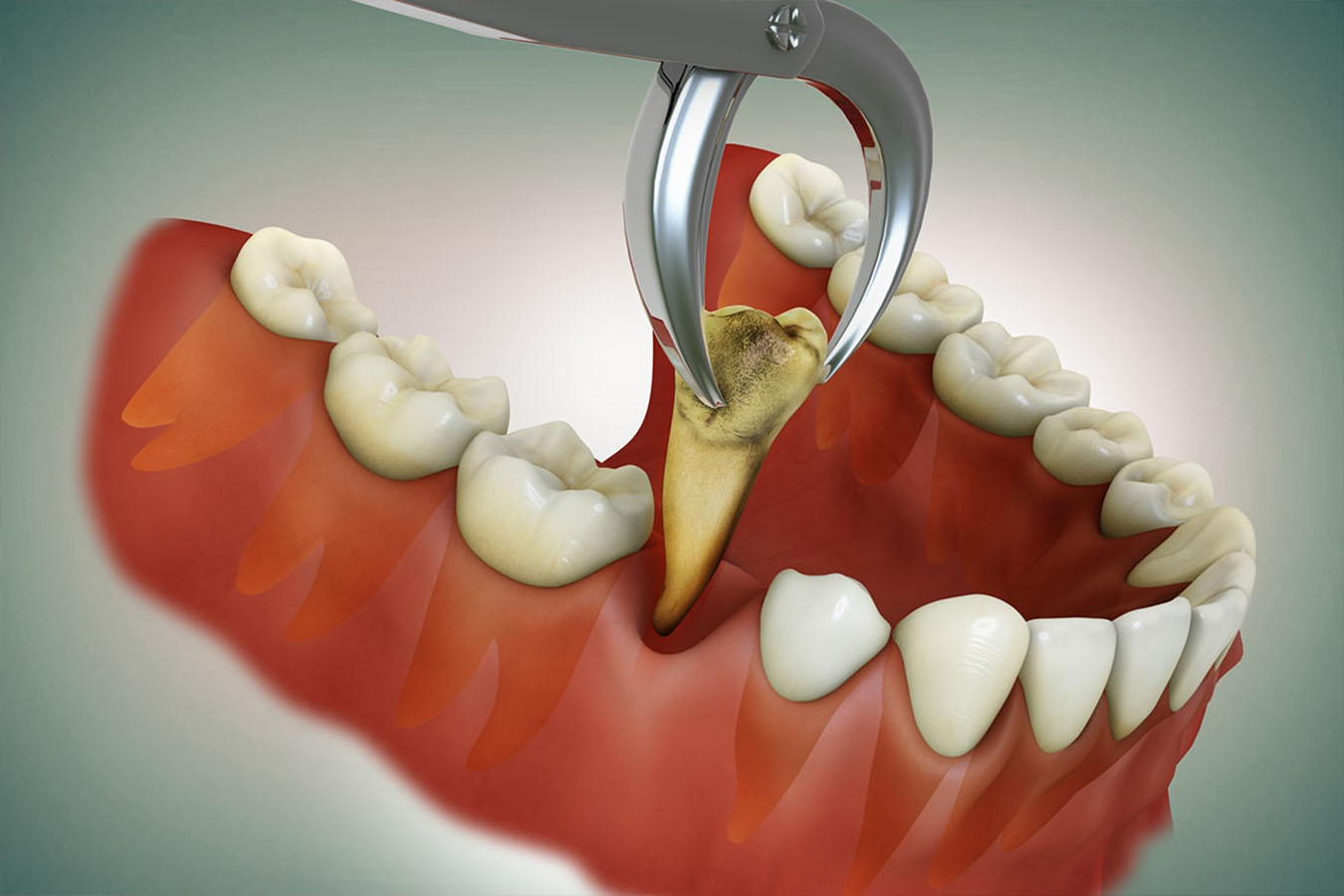 Tooth Extraction in Ulwe