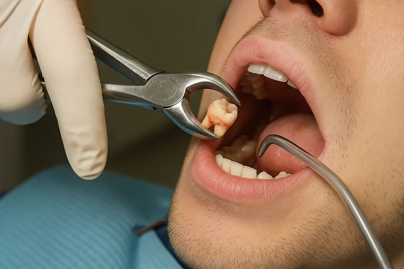 Wisdom Tooth Removal in Ulwe