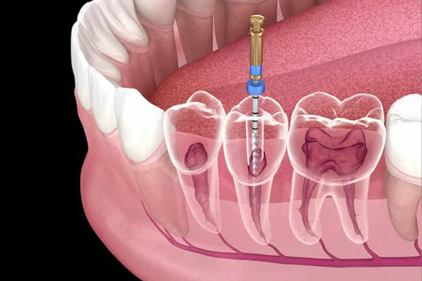 Dental Implants In Ulwe