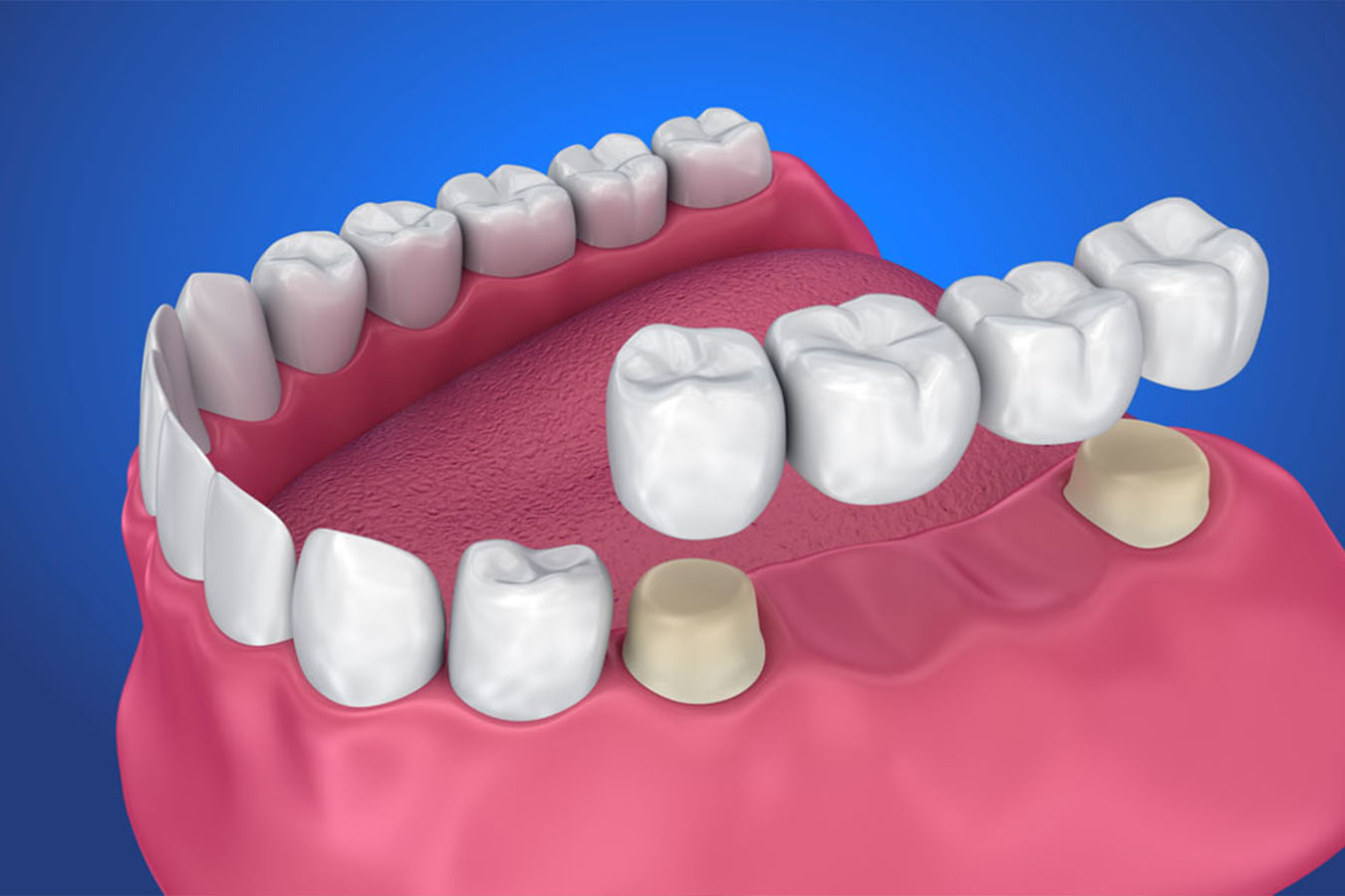 Crown And Bridge Treatment In Ulwe