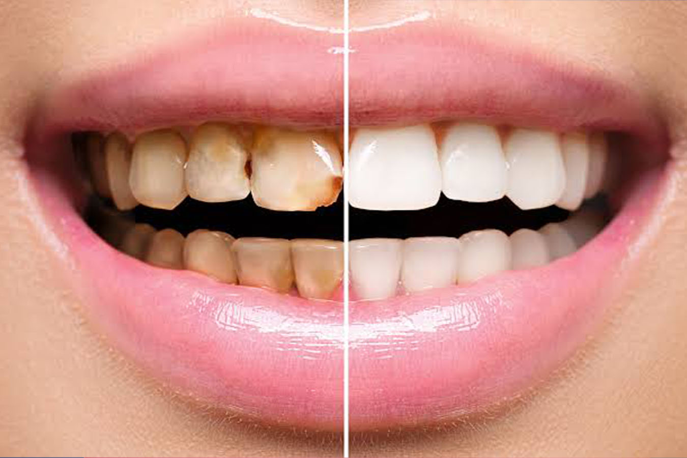 Dental Restoration In Ulwe