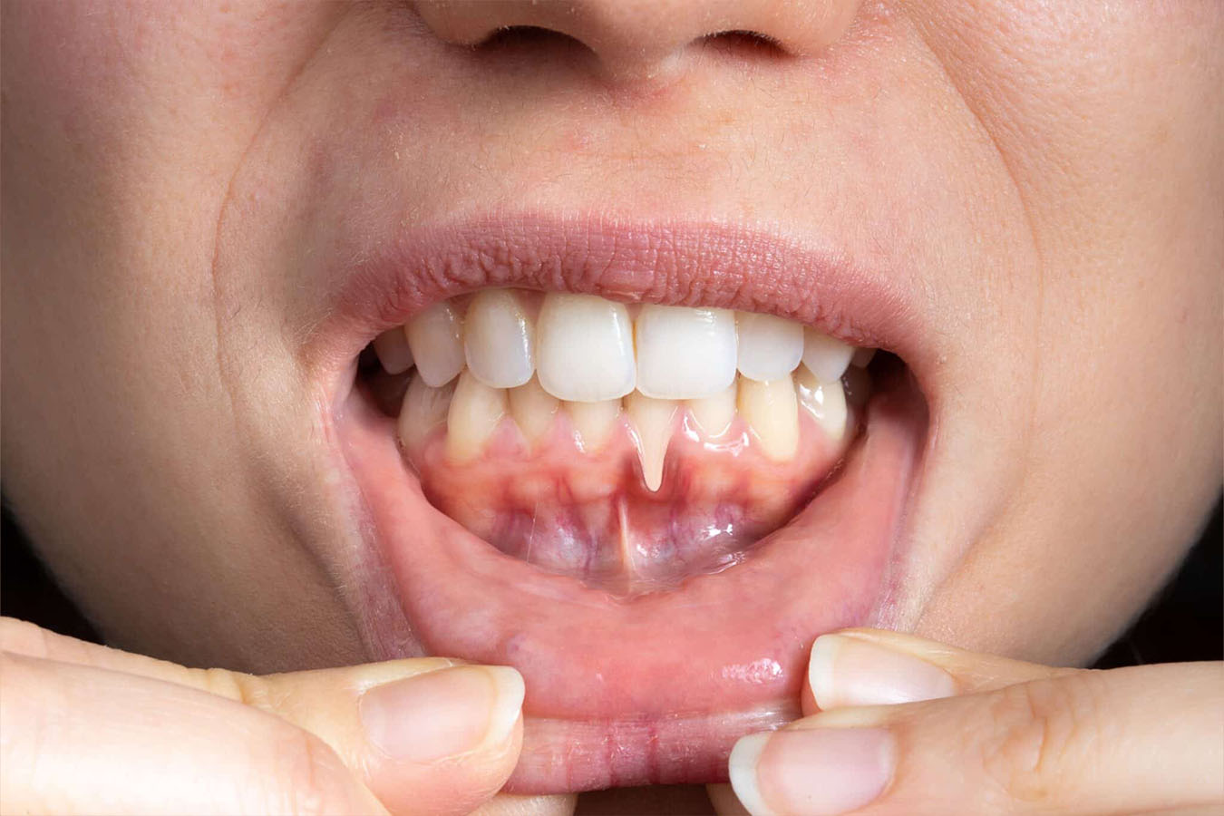 Gum Disease Treatment In Ulwe